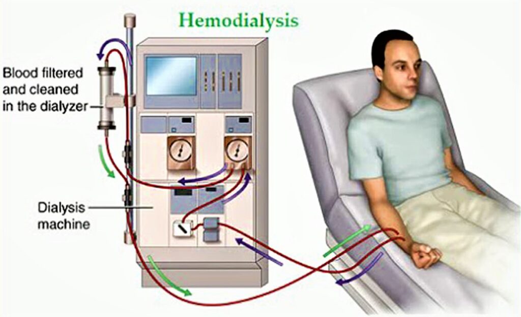 Diagram of hemodialysis treatment