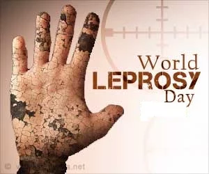 World Leprosy day celebrated on 28th January. Picture Credits: Fb accounts